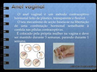 Laqueação e vasectomia.Preservativo4    O preservativo constitui uma barreira à passagem dos espermatozóides para a vagina. A maioria dos preservativos são feitos de látex. Quando usado correctamente, para além de ajudar a prevenir a gravidez, é um método que diminui o risco de contrair DSTs.Métodos Contraceptivos