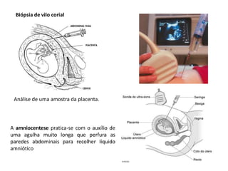 Biópsia de vilo corial

Análise de uma amostra da placenta.

A amniocentese pratica-se com o auxílio de
uma agulha muito longa que perfura as
paredes abdominais para recolher líquido
amniótico

 