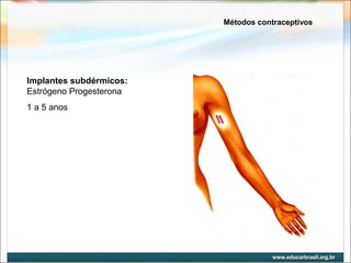 Métodos contraceptivos 
Implantes subdérmicos: 
Estrógeno Progesterona 
1 a 5 anos 
 
