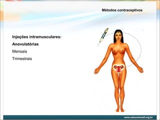 Métodos contraceptivos 
Injeções intramusculares: 
Anovulatórias 
Mensais 
Trimestrais 
 