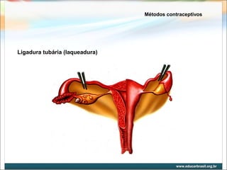 Métodos contraceptivos 
Ligadura tubária (laqueadura) 
 