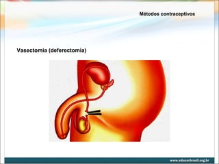 Métodos contraceptivos 
Vasectomia (deferectomia) 
