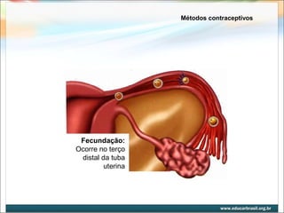 Métodos contraceptivos 
Fecundação: 
Ocorre no terço 
distal da tuba 
uterina 
 