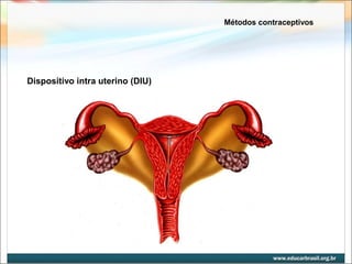 Métodos contraceptivos 
Dispositivo intra uterino (DIU) 
 