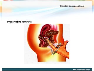 Métodos contraceptivos 
Preservativo feminino 
 