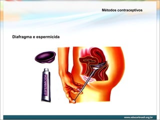 Métodos contraceptivos 
Diafragma e espermicida 
 
