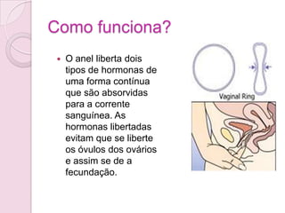 Como aplicar? Com as mãos bem lavadas o anel é colocado na vagina na posição que for mais confortável e empurrado profundamente até não sentir qualquer desconforto.