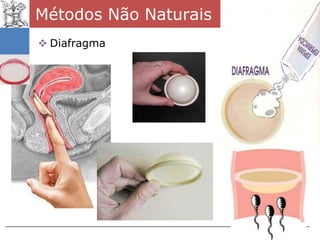 Métodos Não Naturais
 Diafragma
 