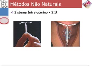 Métodos Não Naturais
 Sistema Intra-uterino - SIU
 