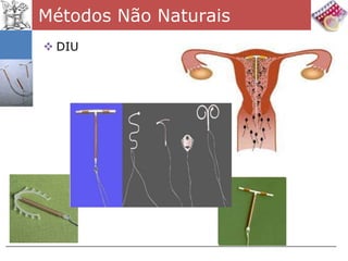 Métodos Não Naturais
 DIU
 
