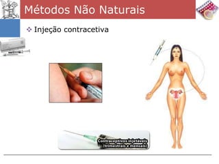 Métodos Não Naturais
 Injeção contracetiva
 