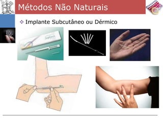 Métodos Não Naturais
 Implante Subcutâneo ou Dérmico
 
