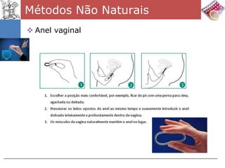 Métodos Não Naturais
 Anel vaginal
 