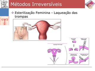 Métodos Irreversíveis
 Esterilização Feminina - Laqueação das
  trompas
 