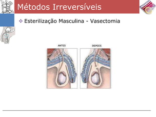 Métodos Irreversíveis
 Esterilização Masculina - Vasectomia
 