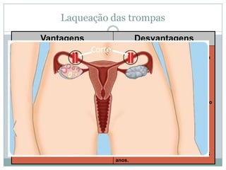 Laqueação das trompas
Vantagens
•A mulher não precisa mais de utilizar
outros meios para evitar a gravidez.
• Eficácia de 100%.
•Sem efeitos secundários.

Desvantagens
•Trata-se de uma cirurgia, portanto com
os mesmos riscos que qualquer outra,
exigindo exames pré-operatórios,
internamento e anestesia.
• A cirurgia é definitiva e irreversível,
pois o retorno favorece gravidez nas
trompas e não é recomendado.
• Várias mulheres se arrependem de não
poder engravidar mais, anos após a
realização da cirurgia, apesar de no
momento da operação terem tido
certeza da escolha.
• Este método não protege contra as
DST.
•Método irreversível.
•Apenas para mulheres com mais de 25
anos.

 