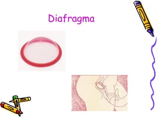 Diafragma
 