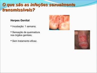 O que são as infeções sexualmente
transmissíveis?

   Herpes Genital

    Incubação: 1 semana;

    Sensação de queimadura
   nos órgãos genitais;

    Sem tratamento eficaz.
 