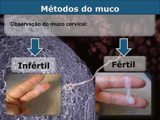 Métodos do muco
Observação do muco cervical:




  Infértil                     Fértil
 