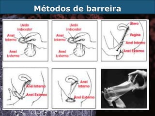 Métodos de barreira
 