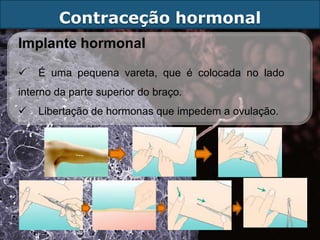 Contraceção hormonal
Implante hormonal
   É uma pequena vareta, que é colocada no lado
interno da parte superior do braço.
   Libertação de hormonas que impedem a ovulação.
 