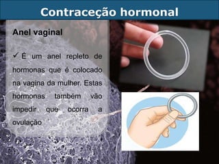 Contraceção hormonal
Anel vaginal

 É um anel repleto de
hormonas que é colocado
na vagina da mulher. Estas
hormonas     também       vão
impedir    que   ocorra    a
ovulação
 