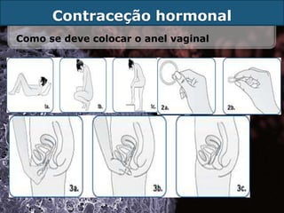 Contraceção hormonal
Como se deve colocar o anel vaginal
 