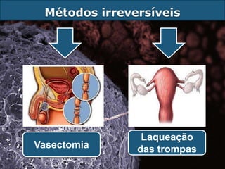 Métodos irreversíveis




                Laqueação
Vasectomia     das trompas
 