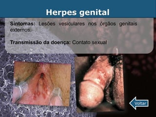 Herpes genital
Sintomas: Lesões vesiculares nos órgãos genitais
externos.

Transmissão da doença: Contato sexual




                                               Voltar
 