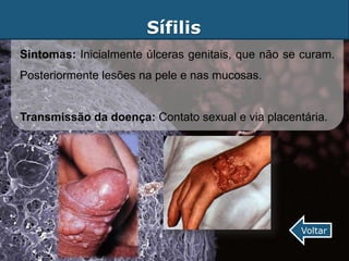Sífilis
Sintomas: Inicialmente úlceras genitais, que não se curam.
Posteriormente lesões na pele e nas mucosas.


Transmissão da doença: Contato sexual e via placentária.




                                                   Voltar
 