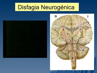 Disfagia Neurogénica  