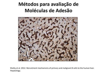 Métodos para avaliação de
Moléculas de Adesão
Shetty et al. 2012. Recruitment mechanisms of primary and malignant B cells to the human liver.
Hepatology.
 