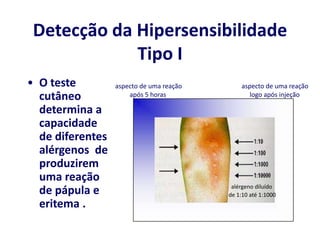Detecção da Hipersensibilidade
Tipo I
• O teste
cutâneo
determina a
capacidade
de diferentes
alérgenos de
produzirem
uma reação
de pápula e
eritema .
aspecto de uma reação
após 5 horas
aspecto de uma reação
logo após injeção
alérgeno diluído
de 1:10 até 1:1000
 