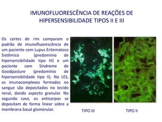 IMUNOFLUORESCÊNCIA DE REAÇÕES DE
HIPERSENSIBILIDADE TIPOS II E III
TIPO III TIPO II
Os cortes de rim comparam o
padrão de imunofluorescência de
um paciente com Lupus Eritematoso
Sistêmico (predomínio de
hipersensibilidade tipo III) e um
paciente com Síndrome de
Goodpasture (predomínio de
hipersensibilidade tipo II). No LES,
os imunocomplexos formados no
sangue são depositados no tecido
renal, dando aspecto granular. No
segundo caso, os anticorpos se
depositam de forma linear sobre a
membrana basal glomerular.
 
