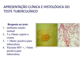 APRESENTAÇÃO CLÍNICA E HISTOLÓGICA DO
TESTE TUBERCULÍNICO
Resposta ao teste:
1. nenhuma reação:
normal
2. 5 a 10mm: repetir o
exame
3. > 10mm: positivo para
tuberculose
4. Paciente HIV +, >5mm:
positivo para
tuberculose
 