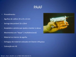 Paaf Métodos de biópsia no cancer de mama | PPTX