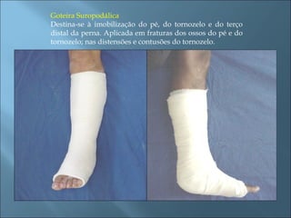 Goteira Suropodálica Destina-se à imobilização do pé, do tornozelo e do terço distal da perna. Aplicada em fraturas dos ossos do pé e do tornozelo; nas distensões e contusões do tornozelo. 