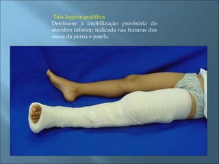 Tala Inguinopodálica Destina-se à imobilização provisória do membro inferior; indicada nas fraturas dos ossos da perna e patela. 