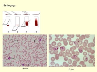 Esfregaço




            Normal   P. vivax
 