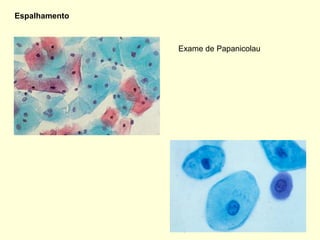 Espalhamento



               Exame de Papanicolau
 