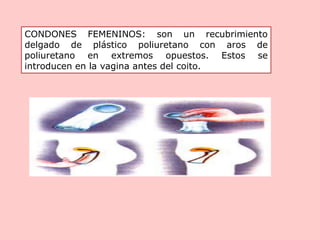 CONDONES FEMENINOS: son un recubrimiento
delgado de plástico poliuretano con aros de
poliuretano en extremos opuestos. Estos se
introducen en la vagina antes del coito.
 