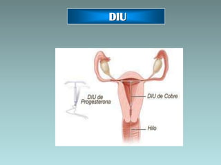 DIU
 