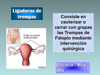 Ligaduras de
  trompas          Consiste en
                   cauterizar o
               cerrar con grapas
                las Trompas de
               Falopio mediante
                  intervención
                    quirúrgica


               Eficacia : Muy
               alta
 