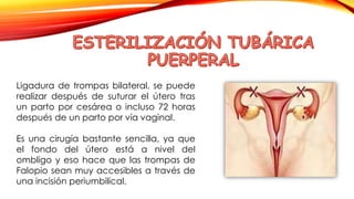 Ligadura de trompas bilateral, se puede 
realizar después de suturar el útero tras 
un parto por cesárea o incluso 72 horas 
después de un parto por vía vaginal. 
Es una cirugía bastante sencilla, ya que 
el fondo del útero está a nivel del 
ombligo y eso hace que las trompas de 
Falopio sean muy accesibles a través de 
una incisión periumbilical. 
 