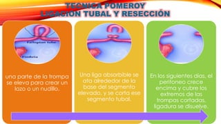 TECNICA POMEROY 
LIGACIÓN TUBAL Y RESECCIÓN 
una parte de la trompa 
se eleva para crear un 
lazo o un nudillo. 
Una liga absorbible se 
ata alrededor de la 
base del segmento 
elevado, y se corta ese 
segmento tubal. 
En los siguientes días, el 
peritoneo crece 
encima y cubre los 
extremos de las 
trompas cortadas, 
ligadura se disuelve. 
 