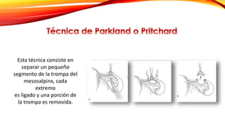 Esta técnica consiste en 
separar un pequeño 
segmento de la trompa del 
mesosalpinx, cada 
extremo 
es ligado y una porción de 
la trompa es removida. 
 