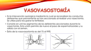 • Es la intervención quirúrgica mediante la cual se recanalizan los conductos 
deferentes que previamente se han seccionado al realizar una vasectomía. 
Se utiliza para recuperar la fertilidad. 
• Consiste en unir los segmentos de los deferentes seccionados durante la 
vasectomía. Esta unión permite de nuevo el paso de espermatozoides y su 
salida con el semen. 
• Éxito de la vasovasostomía es del 75 al 99% 
 