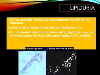LIPIDURIA
Gotas amarillo- traslucido redondeadas de diferentes
tamaños.
Libres o en citoplasma de células tubulares y mc
Px con proteinuria importante o esfingolipidosis como en
la enfermedad de Fabry (luz polarizada: XXX´s malta)
 