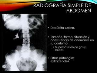 RADIOGRAFÍA SIMPLE DE
ABDOMEN
• Decúbito supino.
• Tamaño, forma, situación y
coexistencia de anomalías en
su contorno.
• Superposición de gas y
heces.
• Otras patologías
extrarrenales.
 
