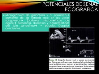 Microgránulos de galactosa y a. palmítico
aumento de las señales eco en los vasos
sanguíneos (burbujas micrométricas de
agua) presencia, dirección y características
del flujo sanguíneo + estudios Doppler
concluidos.
POTENCIALES DE SEÑAL
ECOGRÁFICA
 
